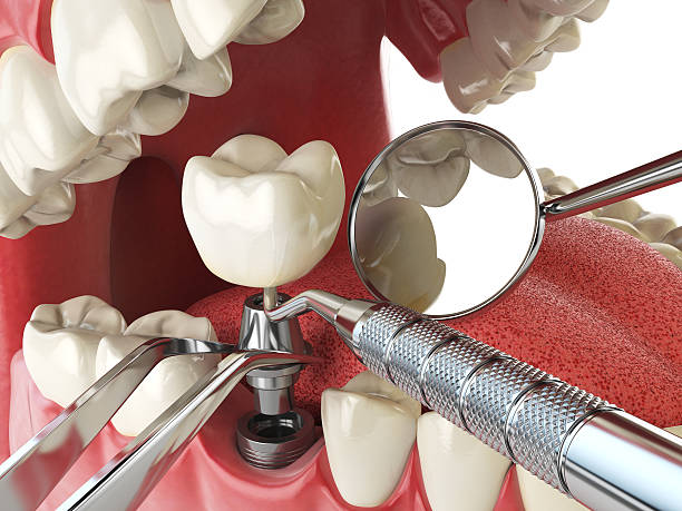Best Emergency Treatment for Dental Infections or Abscesses in Pleasant Gap, PA